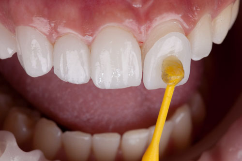 Dán cố định mặt dán sứ vào mặt răng bằng keo dán nha khoa chuyên dụng
