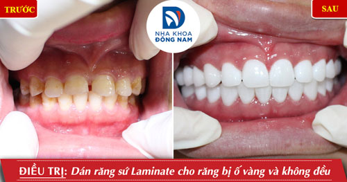 Dán răng sứ Laminate cho răng bị ố vàng và không đều