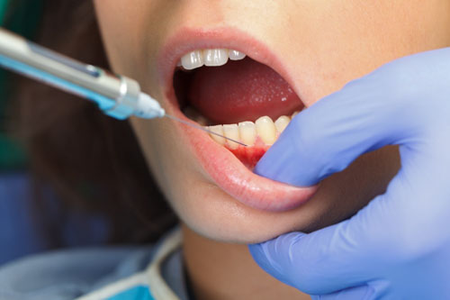 Gây tê trước khi mài răng giúp bệnh nhân không cảm thấy đau đớn khó chịu