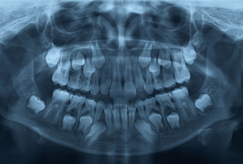 Giai đoạn trẻ thay răng việc bọc sứ có thể sẽ ảnh hưởng đến sự phát triển của răng