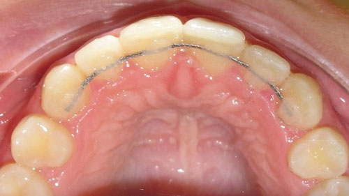 Hàm duy trì cố định được gắn ở mặt trong của răng