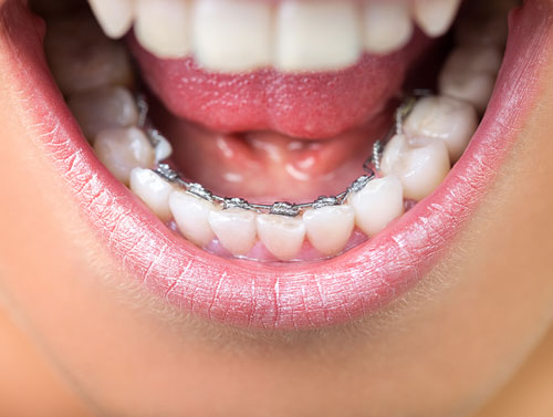 Hệ thống mắc cài được gắn vào mặt trong của thân răng