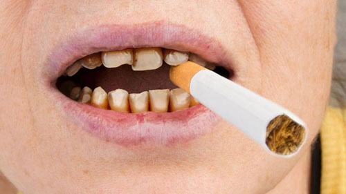 Hút thuốc lá khiến răng ngày càng ố vàng, sậm màu