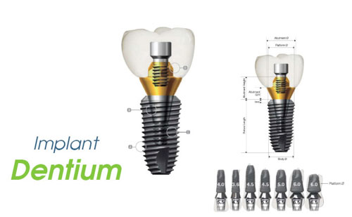 Implant Dentium Hàn Quốc được đánh giá an toàn chất lượng và chi phí thấp