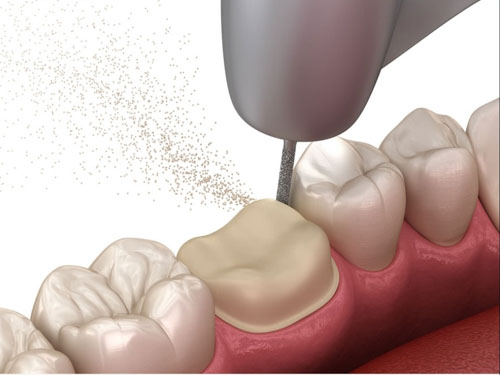 Kỹ thuật mài răng bọc sứ đòi hỏi tỷ lệ chính xác tuyệt đối