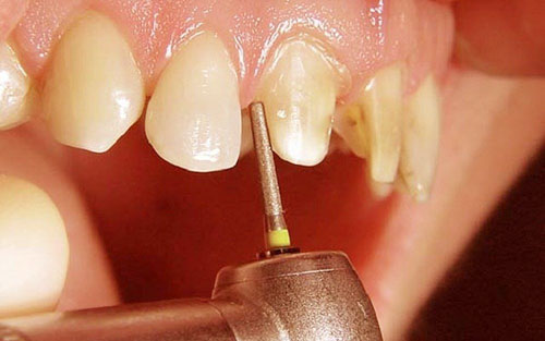 Mài răng cần đảm bảo kỹ thuật và tỷ lệ chuẩn xác tuyệt đối