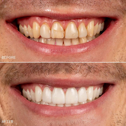 Mặt dán sứ giúp khắc phục hoàn hảo những khuyết điểm nhẹ trên răng