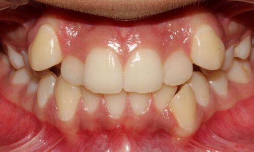 Mặt dán sứ không thể áp dụng cho trường hợp răng khấp khểnh hoặc sai khớp cắn