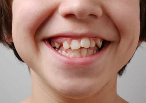 Mất răng sữa sớm sẽ khiến răng vĩnh viễn của trẻ mọc lên lộn xộn