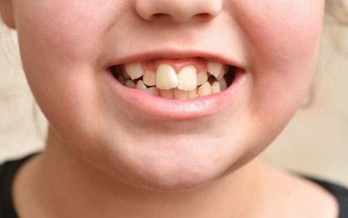 Mất răng sữa sớm sẽ khiến răng vĩnh viễn mọc lệch