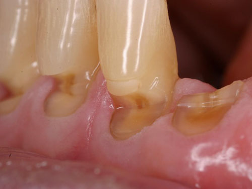 Men răng bị tổn thương cũng là nguyên nhân khiến răng nhạy cảm