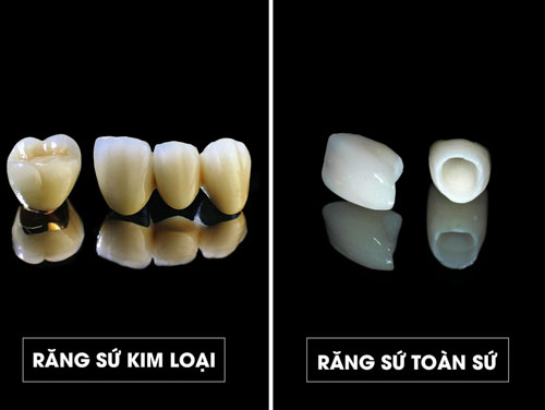 Mỗi loại răng sứ sẽ có giá thành khác nhau