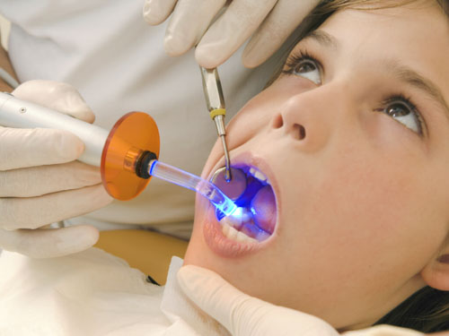 Nếu răng sữa của trẻ bị sâu hay sứt mẻ việc điều trị trám bít là rất cần thiết