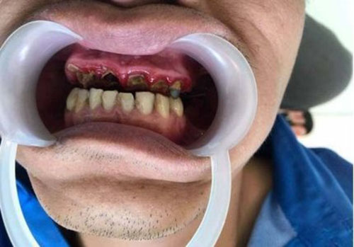 Nguy cơ hư hỏng trụ răng thật do bọc sứ sai kỹ thuật