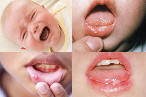 Nhiệt miệng ở trẻ em có thể do nhiều nguyên nhân gây nên