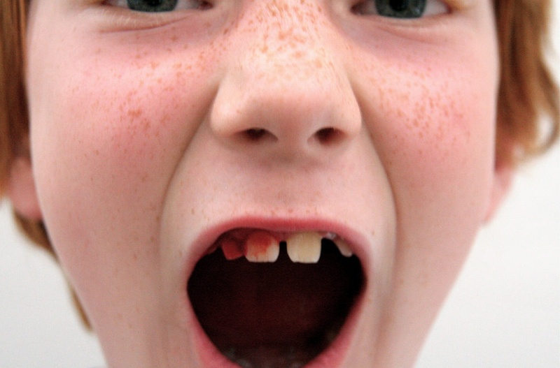 Những rủi ro nhổ răng tại nhà có thể ảnh hưởng hướng răng mọc vĩnh viễn sau này