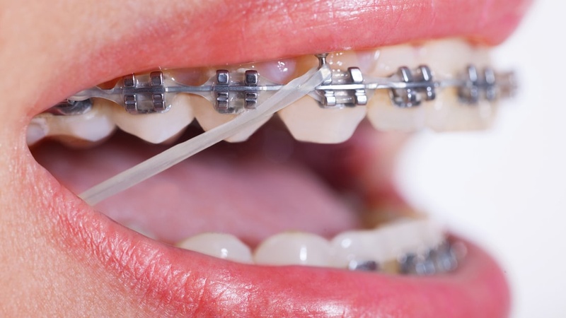 Niềng răng chỉnh nha mất từ 1 – 3 năm