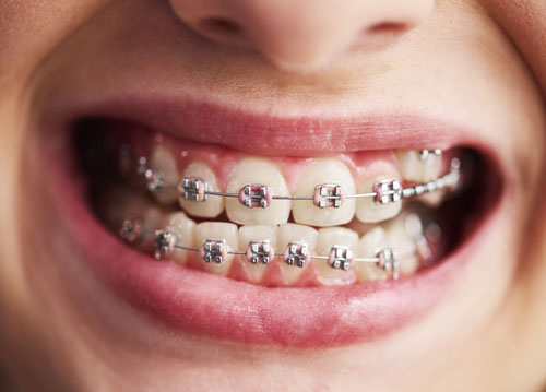 Niềng răng cho răng móm sẽ giúp bảo tồn răng thật tối đa
