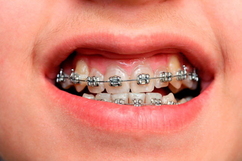 Niềng răng giúp cải thiện tình trạng cười hở lợi ở mức độ nhẹ