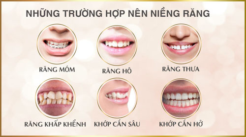 Niềng răng phù hợp cho nhiều trường hợp răng lệch lạc
