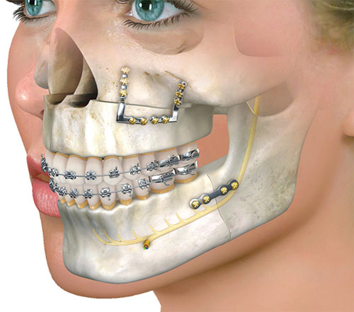 Phẫu thuật hàm kết hợp với niềng răng cho những bệnh nhân vừa hô răng vừa hô hàm