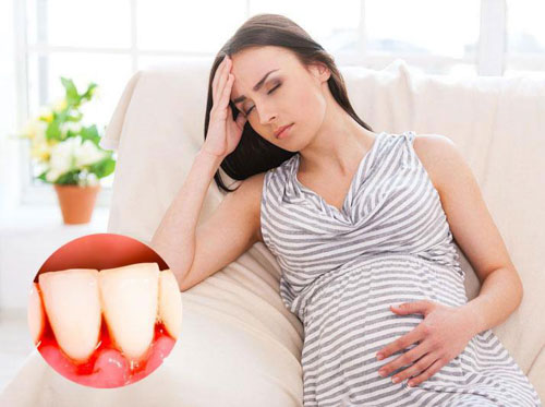 Phụ nữ mang thai là đối tượng có nguy cơ bị chảy máu chân răng khá cao