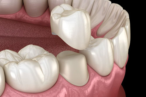 Phương pháp bọc răng sứ chỉ áp dụng cho trường hợp răng vẩu nhẹ