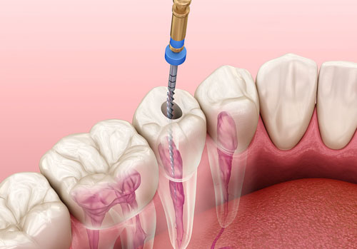 Răng đã lấy tủy sẽ có tuổi thọ không cao bằng răng khỏe mạnh