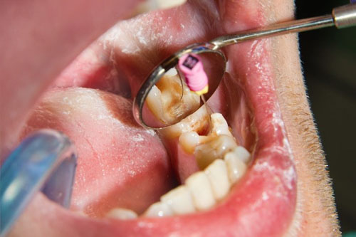 Răng ê buốt do tủy răng bị viêm nhiễm cần tiến hành điều trị tủy răng