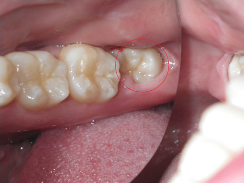 Răng khôn mọc vào độ tuổi trưởng thành khi các răng khác và xương hàm đã phát triển hoàn thiện