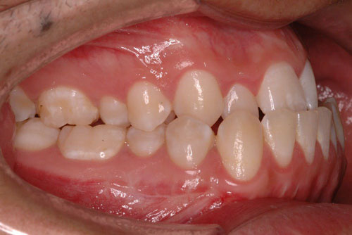 Răng móm là tình trạng răng hàm dưới chìa ra ngoài bao phủ răng hàm trên