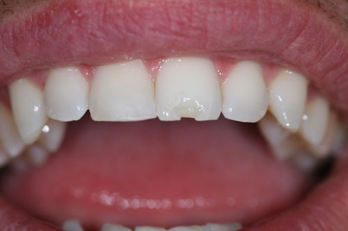 Răng sứ kém chất lượng rất dễ bị sứt mẻ