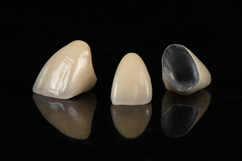 Răng sứ kim loại có màu hơi đục
