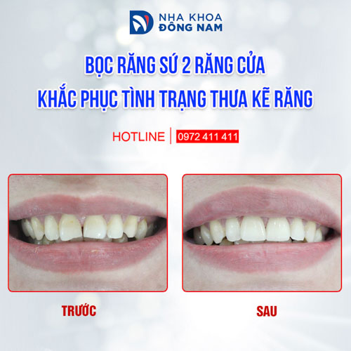 Răng thẩm mỹ hơn sau khi bọc sứ