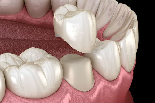 Răng thật được mài theo tỷ lệ nhất định để làm trụ chụp mão sứ lên trên