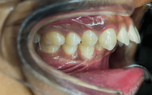 Răng vẩu do xương hàm trên phát triển quá mức