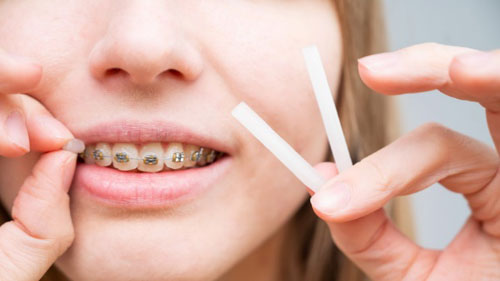 Sáp nha khoa là vật dụng cần thiết dành cho người niềng răng mắc cài