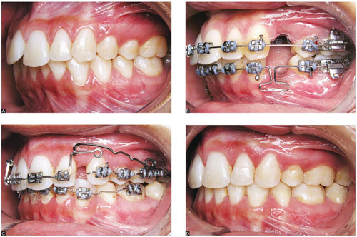 Sau mỗi giai đoạn răng đều có những thay đổi nhất định