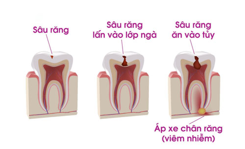 Sâu răng là nguyên nhân chính gây ra các bệnh lý tủy răng