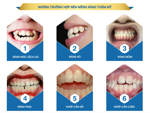 Sử dụng khí cụ chỉnh nha để điều chỉnh răng mọc lệch về đúng vị trí