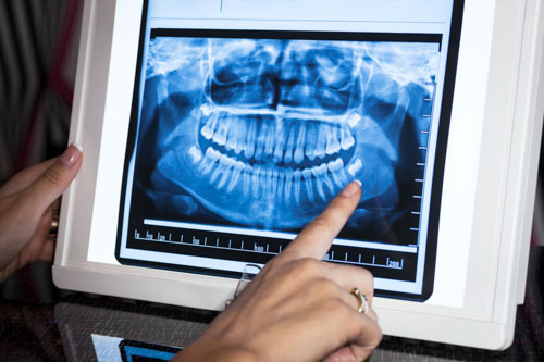 Thăm khám tại nha khoa để xác định chính xác tình trạng răng khôn
