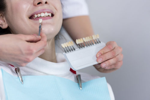 Thời gian bọc răng sứ thường mất ít nhất khoảng 2 – 4 ngày là hoàn thành