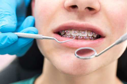 Thời gian niềng răng thường kéo dài từ 18 – 36 tháng