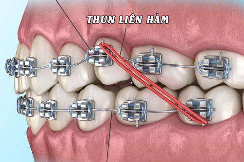 Thun liên hàm được dùng cho các trường hợp răng khấp khểnh