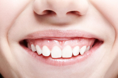 Tình trạng răng vẩu kèm với cười hở lợi