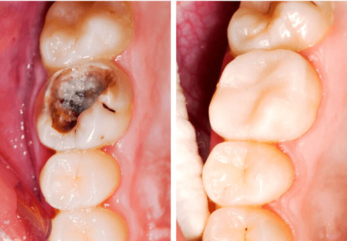 Trám răng điều trị với trường hợp răng sâu nặng