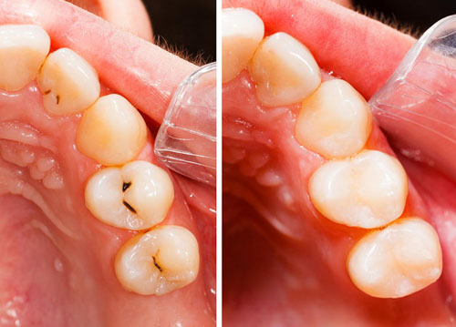 Trám răng phòng giám sát cho trẻ khi răng mới trưởng sâu
