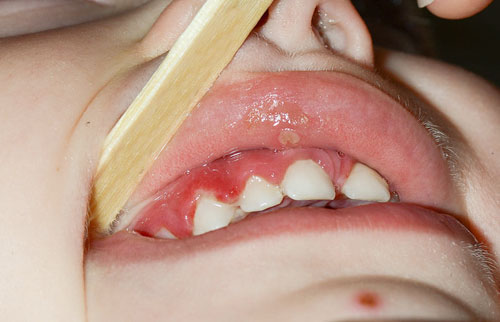 Trẻ bị viêm nướu cũng dễ gặp tình trạng chảy máu chân răng
