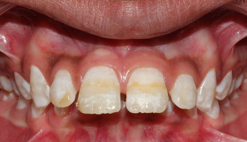 Trường hợp hô do xương hàm thì phương pháp bọc răng sứ sẽ không có tác dụng