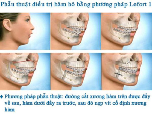 Trường hợp răng hô vẩu do hàm cần phải phẫu thuật để khắc phục triệt để